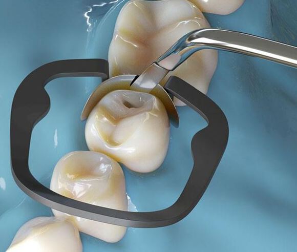 Akro-flex composietinstrument