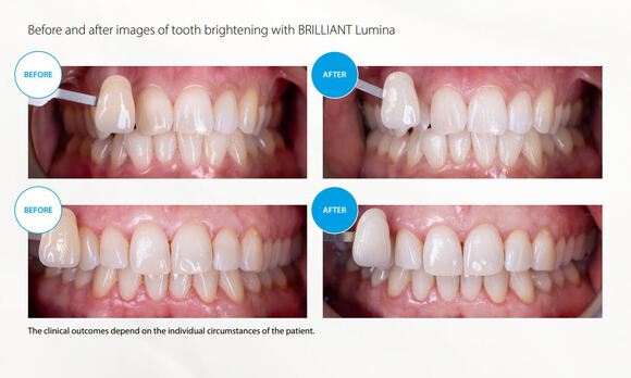 Brilliant lumina basiskit