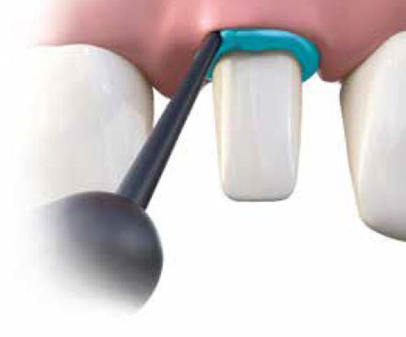 Retraction paste