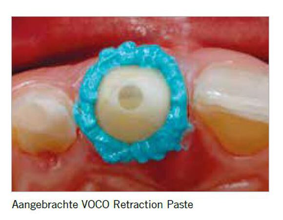 Retraction paste