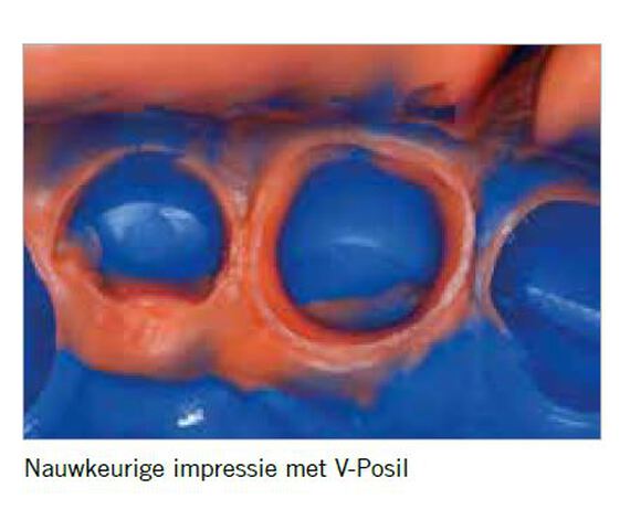 Retraction paste
