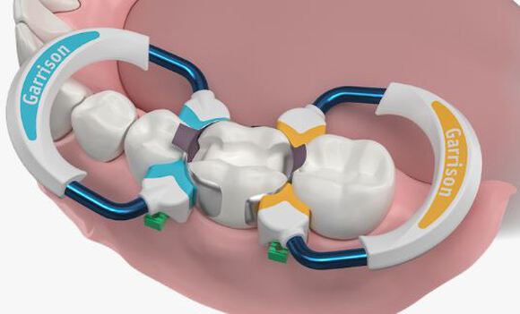 Strata-g sectional matrix standaard set
