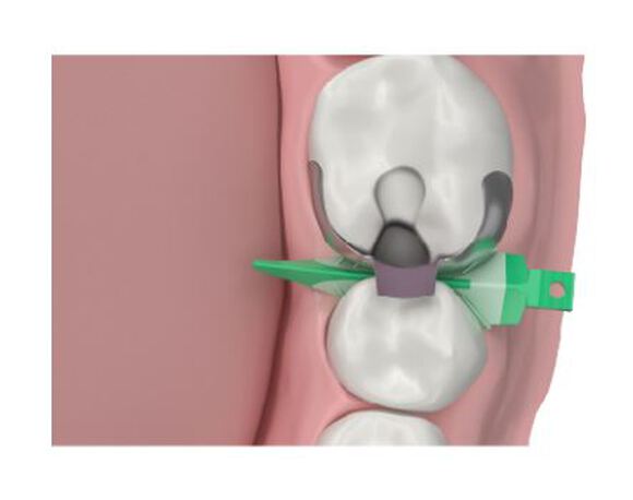 Strata-g wiggen interproximal wedge kit