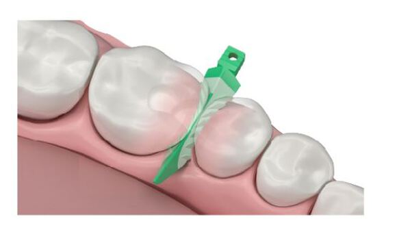 Strata-g wiggen interproximal wedge kit