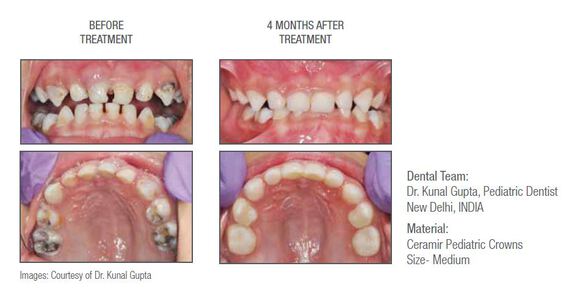 Ceramir pediatric crown 85/t medium