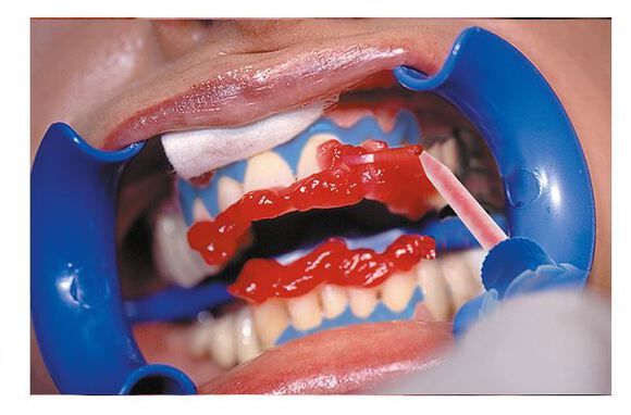 Bleach'n smile gel 35% hydrogen peroxide refill