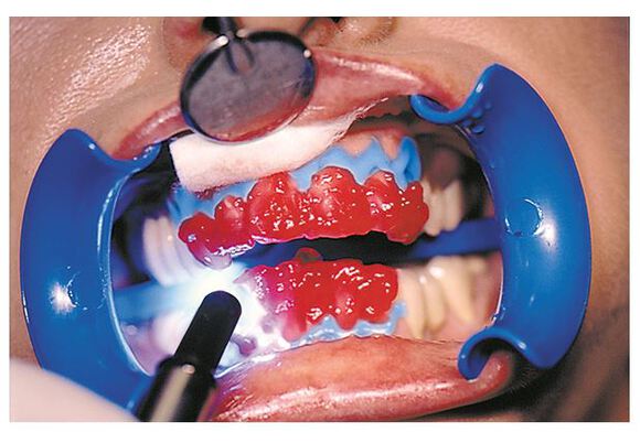 Bleach'n smile gel 35% hydrogen peroxide refill
