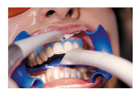 Bleach'n smile dental dam set