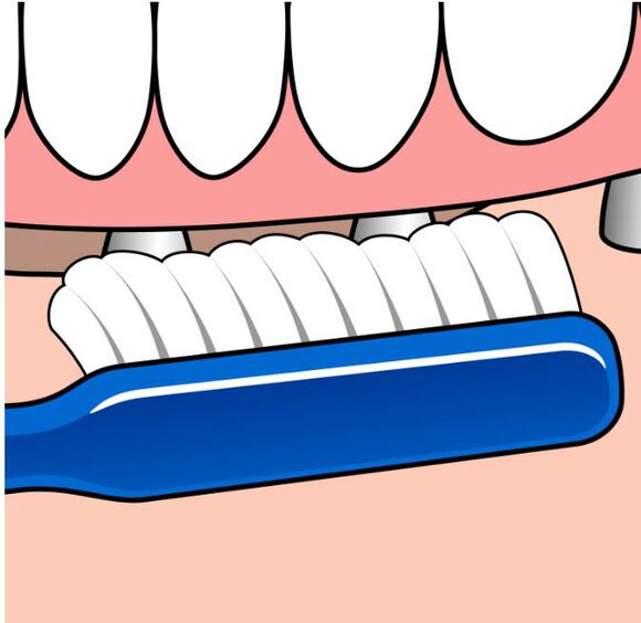 Tepe implant/orthodontie tandenborstel