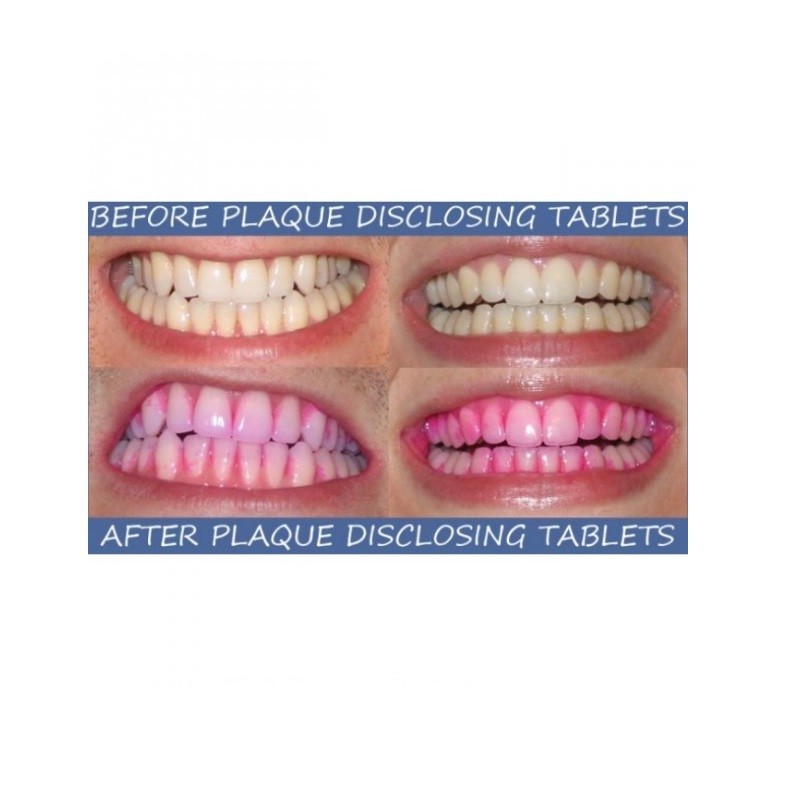 Gum red-cote plakverklikker / disclosing