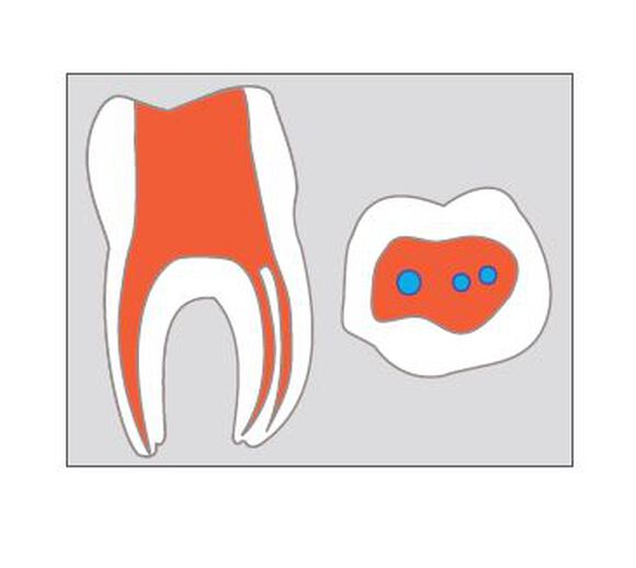 Edenta endobur h1snl.206.008 raxl rond