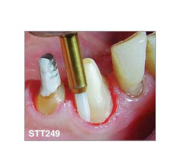 Edenta soft tissue trimmer stt249/016 fg 5mm